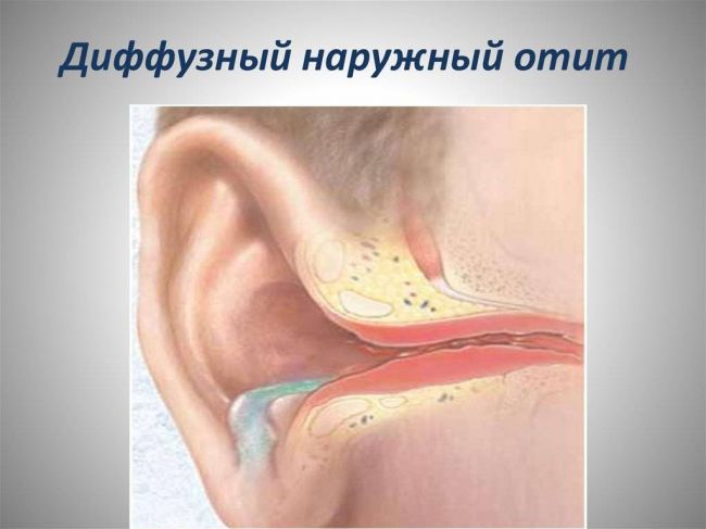 Ухо заложило и болит – чем лечить отит после орви