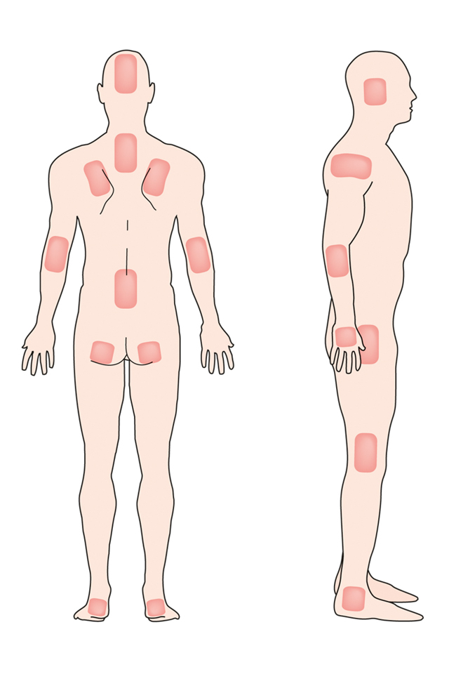 Лечение пролежней у лежачих больных | полезные знания для всех