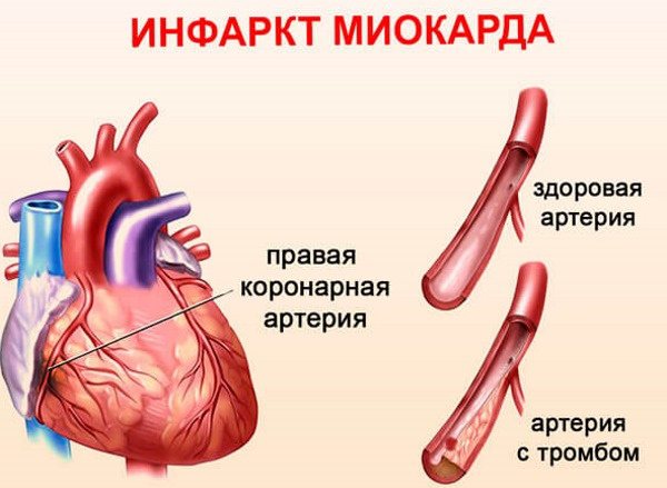 Инструкция по применению препарата милдронат