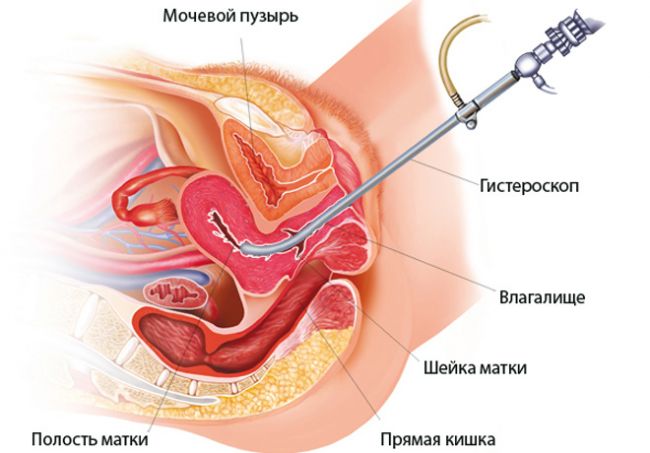 Железистая гиперплазия эндометрия