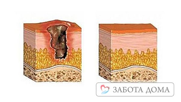 Опрелости и пролежни: как лечить на разных стадиях
