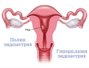 Железистая гиперплазия эндометрия