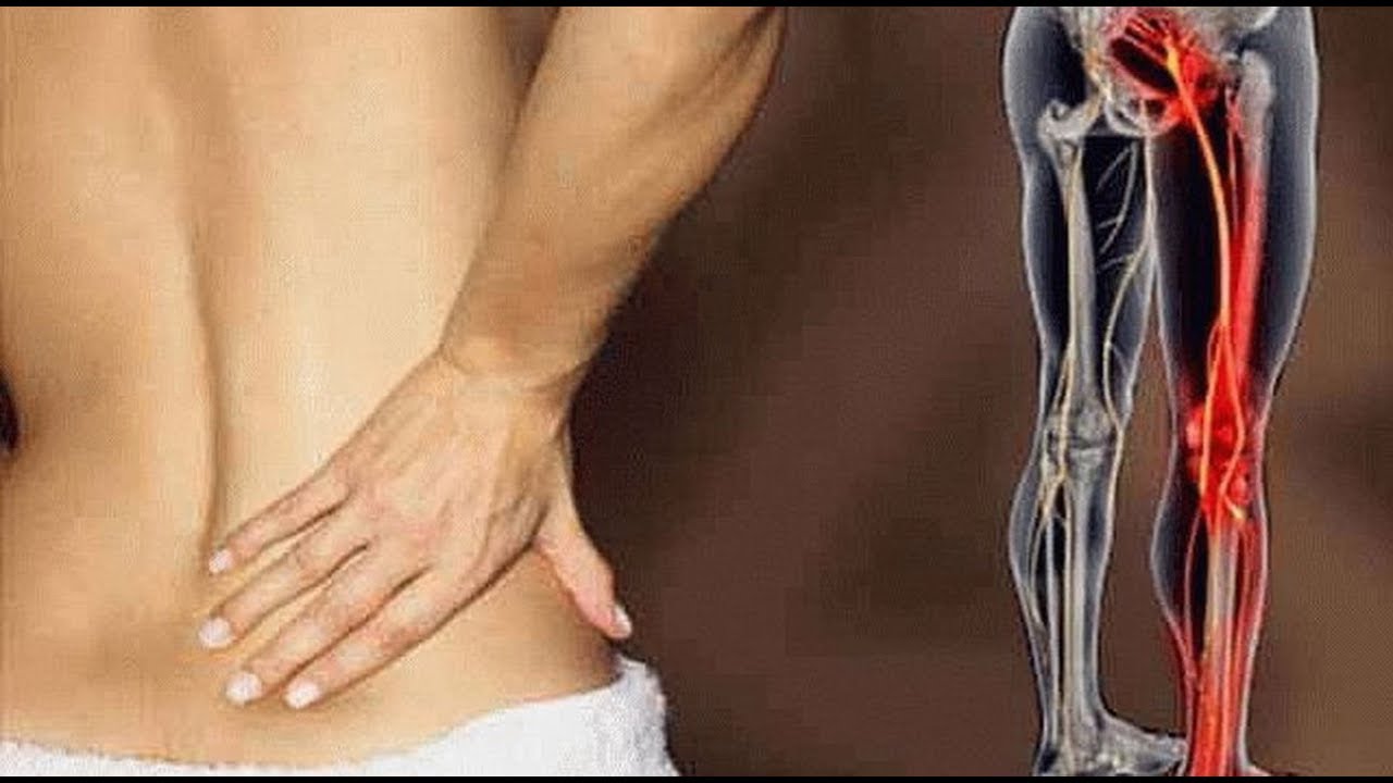 Причины, симптомы и лечение защемления нерва