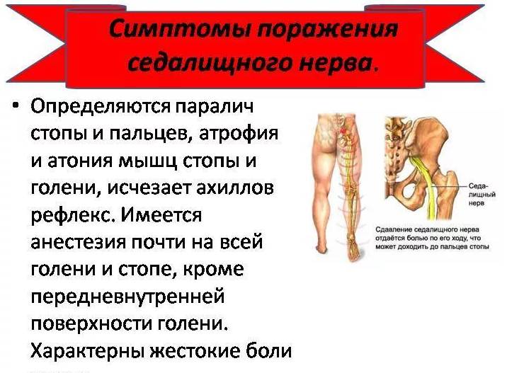 Чем лечат защемление нерва. защемление нерва, лечение в домашних условиях