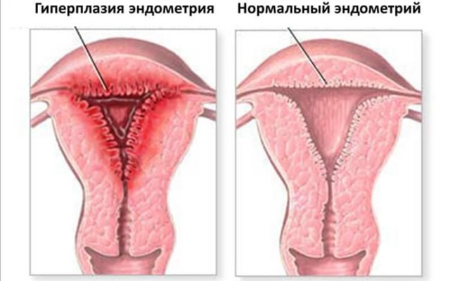 Очаговая гиперплазия эндометрия: что это, лечение и причины