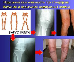 Меню при коксартрозе тазобедренного сустава