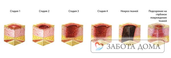Опрелости и пролежни: как лечить на разных стадиях