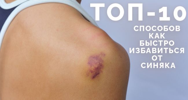 Появился ушиб, синяк, гематома? все поправимо, если правильно подобрать средство!