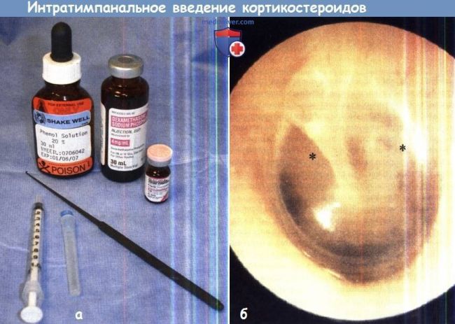 Тугоухость: лечение, причины, симптомы. как лечить тугоухость?