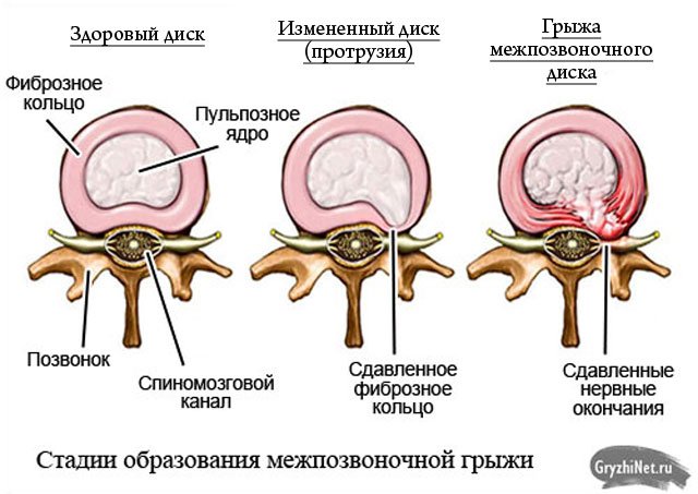 Чем опасна грыжа: почему нельзя запускать болезнь