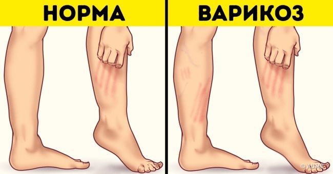 Как убрать синяк на лице