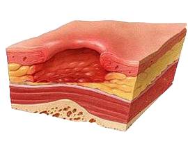 Чем лечить пролежни