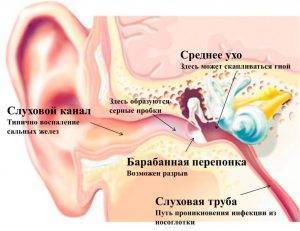 Антибиотики и капли в уши при отите