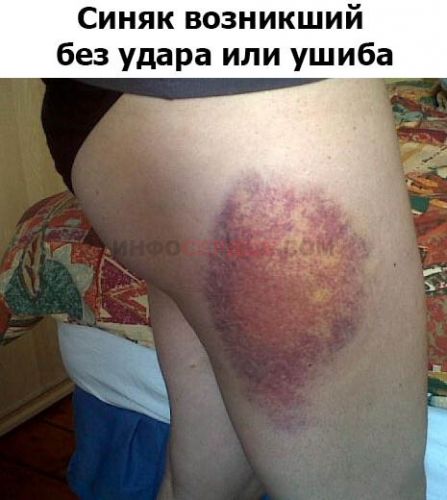 Стадии прохождения гематомы (синяка) и как ускорить процесс