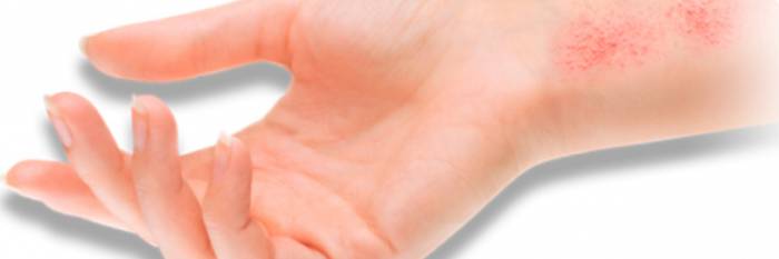 Аллергический дерматит: характерные симптомы и эффективное лечение у взрослых