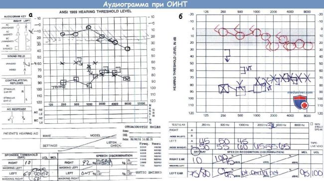 Нейросенсорная тугоухость: симптомы и лечение 1-4 степеней у взрослых и детей