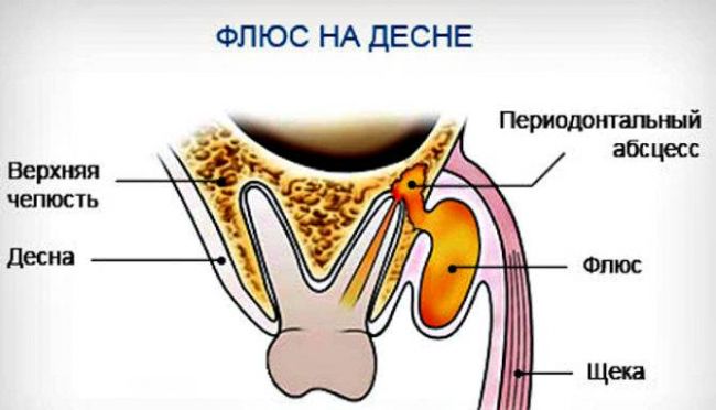Гингивит - симптомы и лечение