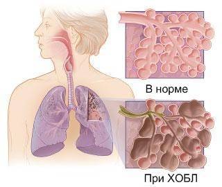 Хобл – заболевание легких: лечение и симптомы, список препаратов