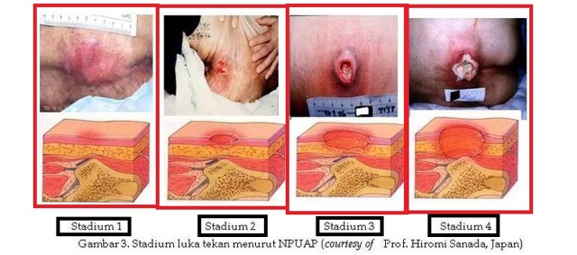 Как избежать и недопустить пролежней у больгого, народные способы лечения пролежней