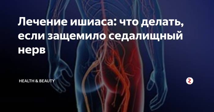Защемление корешкового нерва в пояснице