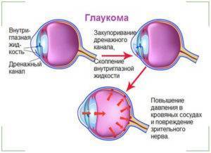 Медленно или резко падает зрение: что делать и как бороться?