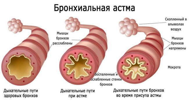 Пониженная температура при простуде