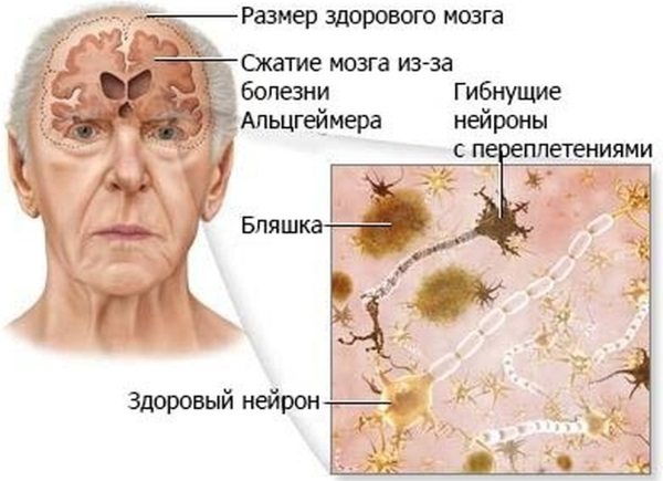 Деменция.ру