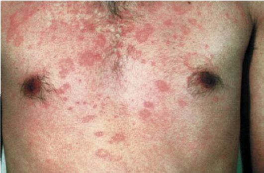 Аллергический дерматит: симптомы и лечение аллергического дерматита у детей и взрослых