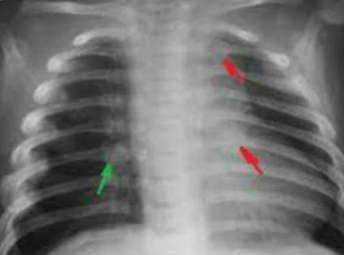 При вздохе болит правый бок под ребрами