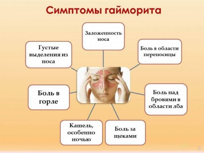 Кашель при гайморите