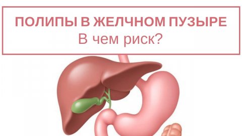 Как лечится холестериновый полип желчного пузыря?