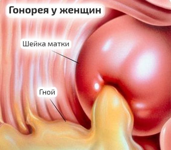 Кишечная палочка: симптомы и лечение у детей и взрослых