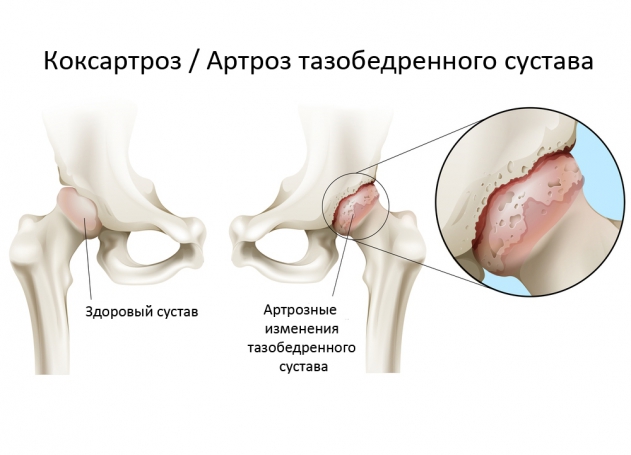 Диета при коксартрозе