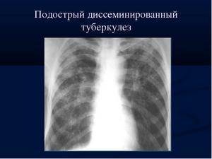 Инфильтративный туберкулез легких