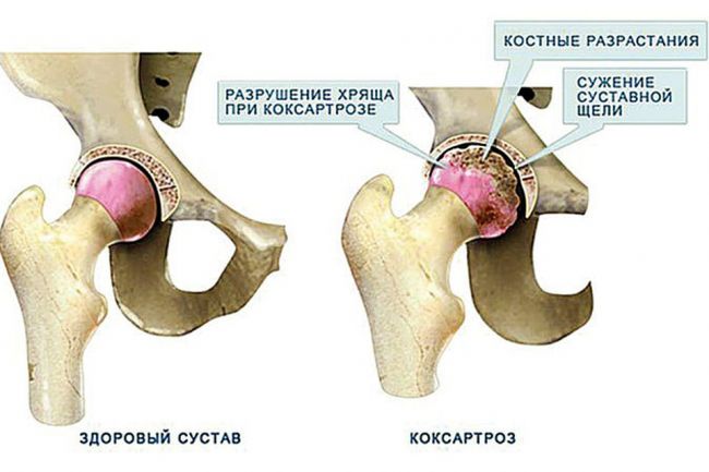 Питание при коксартрозе тазобедренного сустава лечение