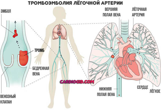 Тромбоз: причины, симптомы, лечение, профилактика