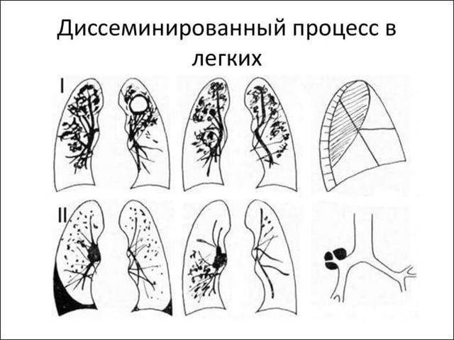 Диссеминированный туберкулез легких в стадии распада и инфильтрации: дифференциальная диагностика и симптомы, лечение