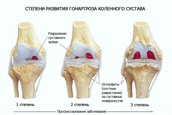 Меню при коксартрозе тазобедренного сустава 2