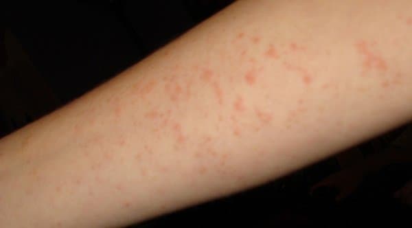 Аллергический дерматит – симптомы и лечение, дерматит на руках и на лице