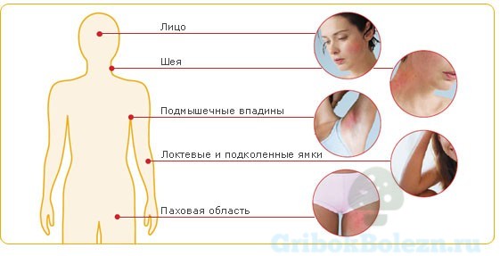 Аллергический дерматит: симптомы и лечение аллергического дерматита у детей и взрослых