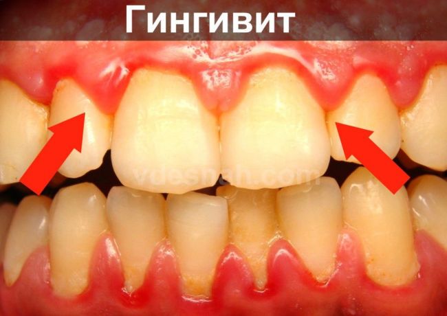 Гингивит: симптомы и лечение, фото болезни у взрослых