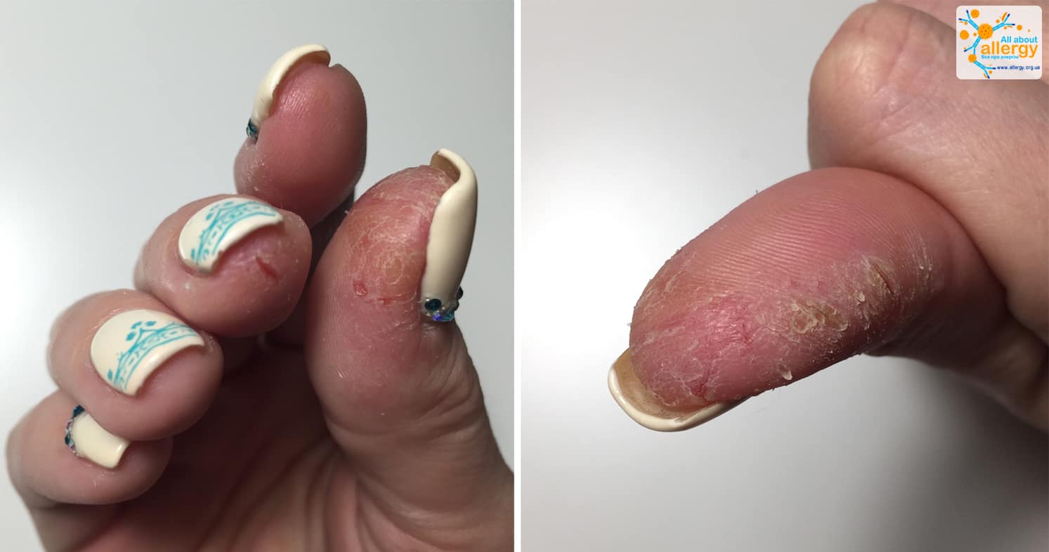 Заражение аллергическим дерматитом, основные симптомы и методы лечения у взрослых