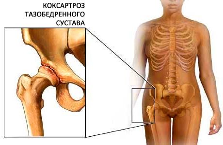 Меню при коксартрозе тазобедренного сустава 2