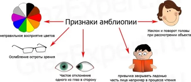 Классификация амблиопии: по степени и причинам