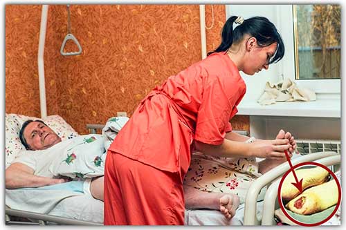 Чем лечить пролежни