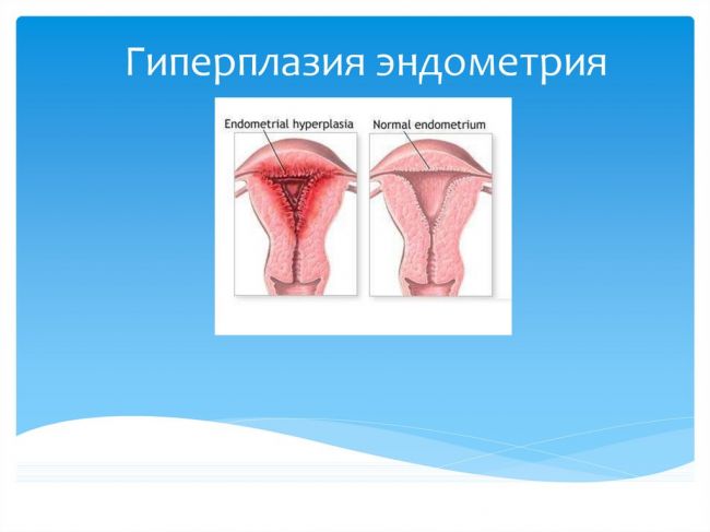 Железистая гиперплазия эндометрия: особенности, типы, лечение заболевания