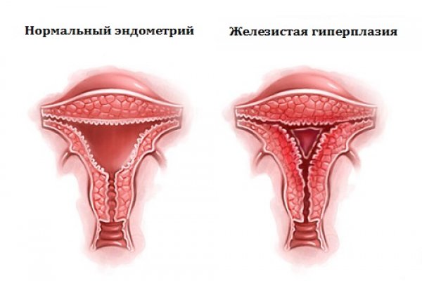 Гиперплазия эндометрия – симптомы, лечение, железистая гиперплазия эндометрия