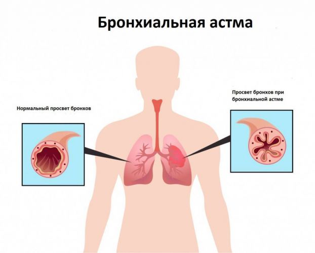 Кашель при гайморите: причины и симптомы
