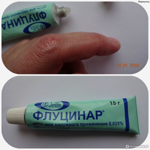 Флуцинар — отзывы, цена, аналоги, форма выпуска