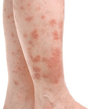 Аллергический дерматит у детей (29 фото): симптомы и лечение грудничков и новорожденных, кремы и мази в домашних условиях